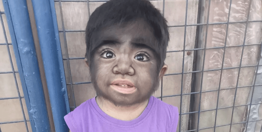 Хлопчик із рідкісним захворюванням, схожий на перевертня, синдром перевертня, гіпертрихоз, рідкісне захворювання, з'їла кішку, прокляття