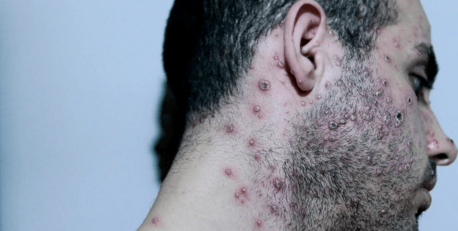 оспа, мужчина, оспа обезьян