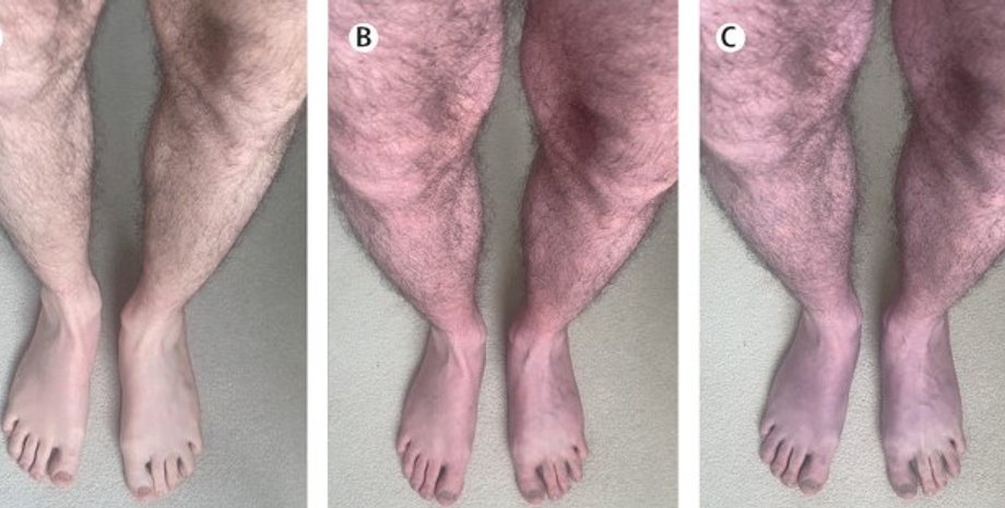 ноги, коронавірус