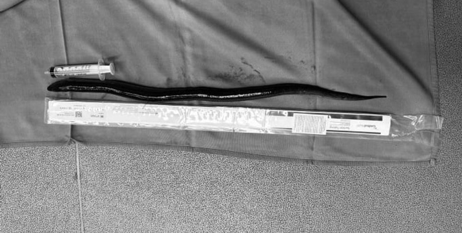 Живий вугор заліз у тіло чоловіка, операція на кишківнику, хірургічне втручання, В'єтнам, фото