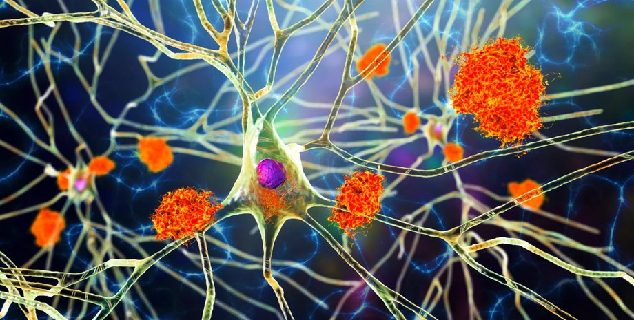 болезнь альцгеймера