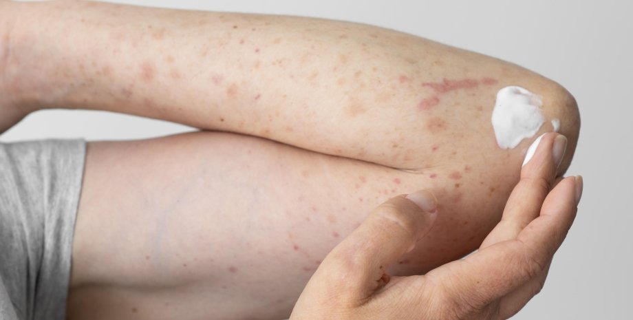 псориаз, аллергия, воспаление на коже