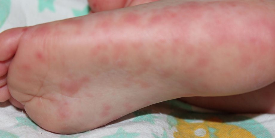 Вірус Коксакі У МОЗ розповіли про головні симптоми вірусу Коксакі