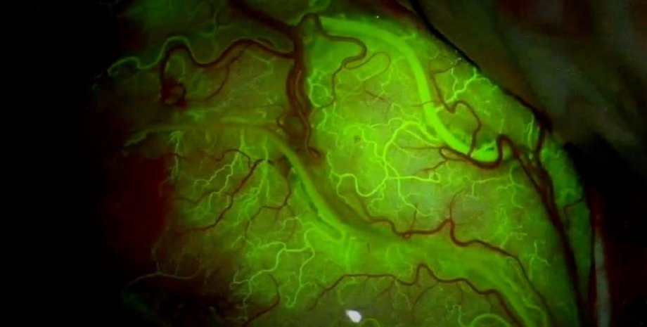 мозг, ультразвуковая терапия, мозг контраст, контраст в мозгу