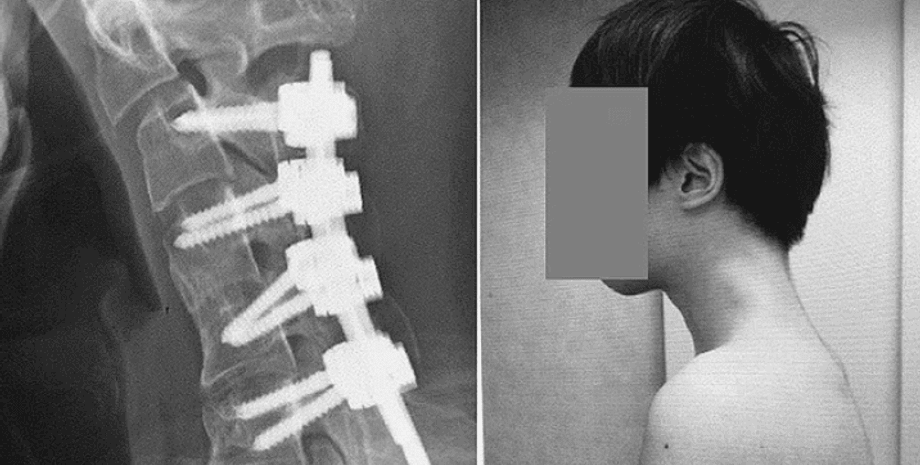 Японцу сделали сложнейшую операцию на позвоночнике из-за чрезмерного использования смартфона