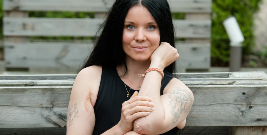 Мария Жампачева, расстройство, странный диагноз, генетическое заболевание, проблемы с кожей, фото, Чехия