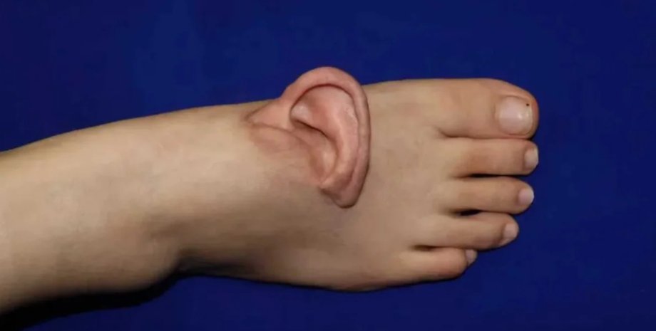 вухо, вухо на нозі, трансплантація