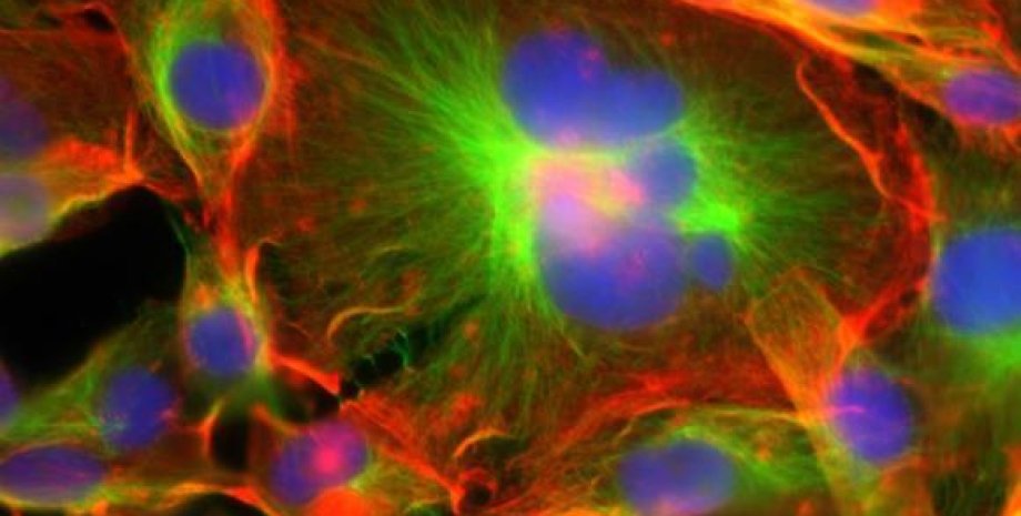 Гигантские раковые клетки, выделенные синим цветом. Фото: Michelle Dawson / Brown University