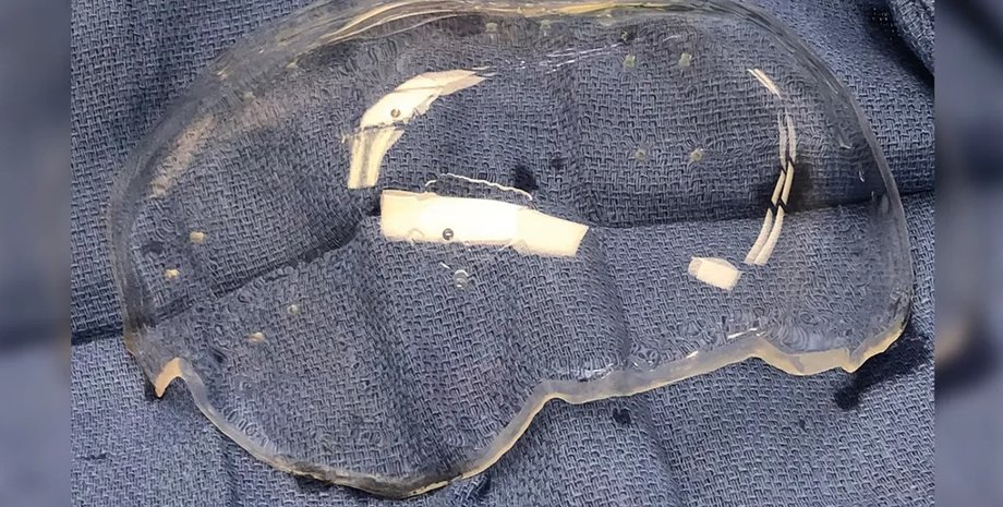 імплантат, мозок, прозорий імплантат