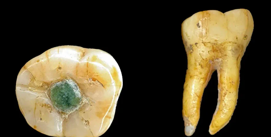 Мая пломбували зуби