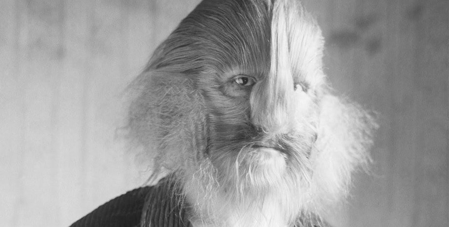 Мужчина с лицом льва, Лайонел, парень с лицом льва, мужчина-лев, цирковой артист, гимнаст, мировая знаменитость, цирк