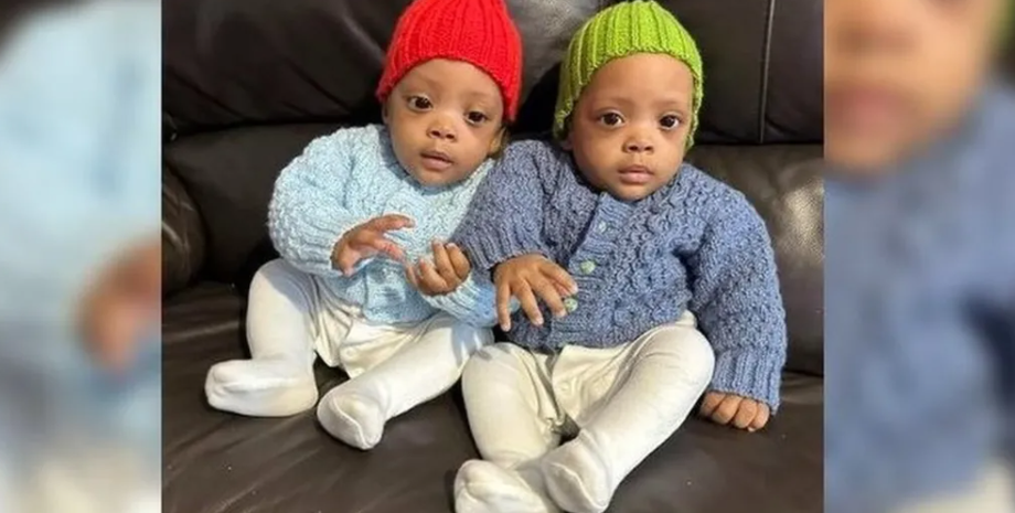 Сіамських близнюків з Великої Британії роз'єднали, операція, хірургія, діагнози