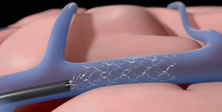 Stentrode, мозговой имплант