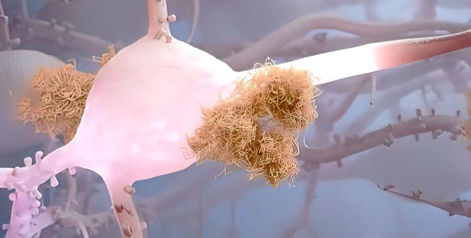 хвороба Альцгеймера