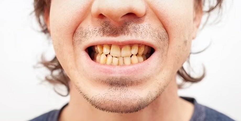 желтые зубы