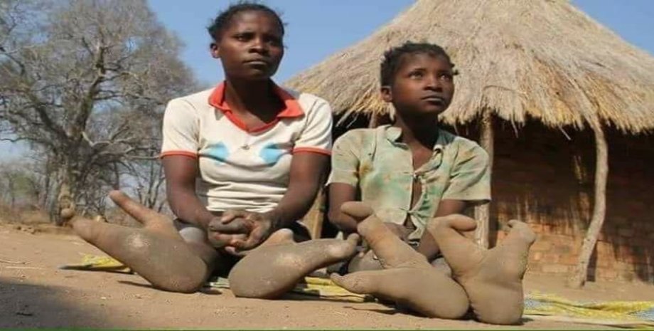 Люди из племени Вадома, люди-страусы, синдром "клешни омара", тайна племени, загадка племени, ноги без трех пальцев