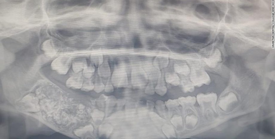 Рентген челюсти 7-летнего ребенка. Фото: Saveetha Dental College and Hospital