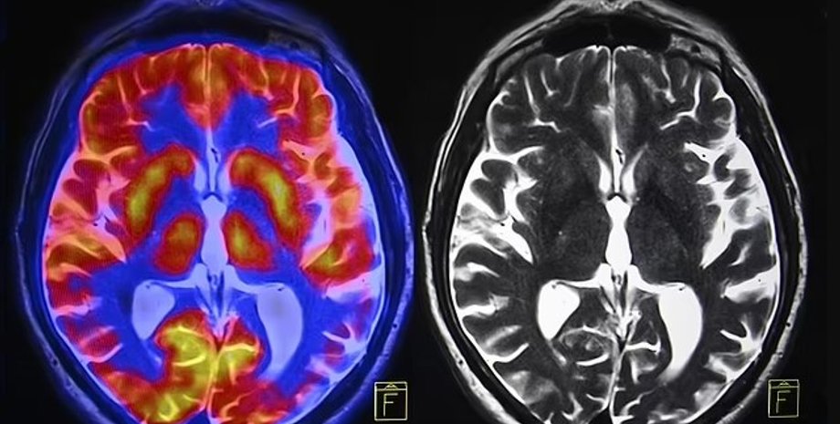 мозг, различия в мозге, мозг мужчин и женщин