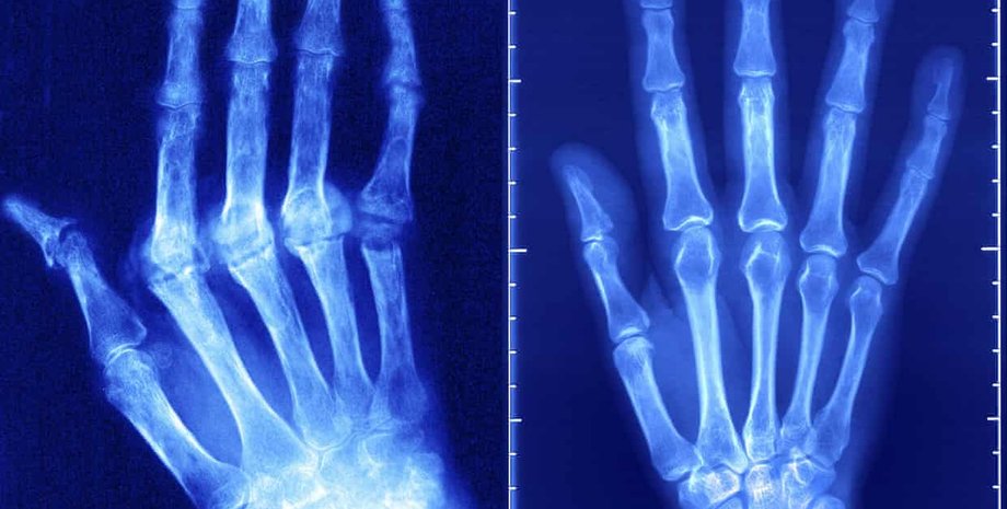 ревматоидный артрит, аутоиммунные заболевания