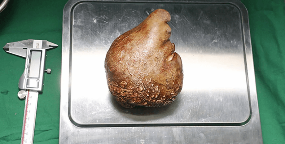 камень, почки