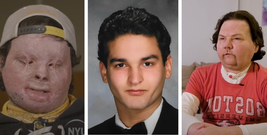 Джо Дімі, пересадка обличчя, колаж, успішна операція