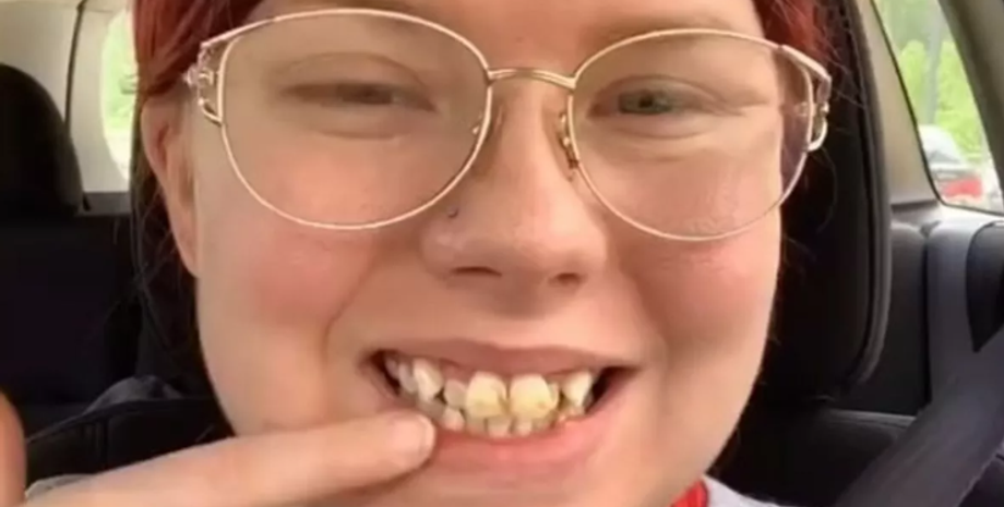 Как выровнять кривые зубы, женщина показала результат ухода за зубами, улыбка до и после посещения стоматолога