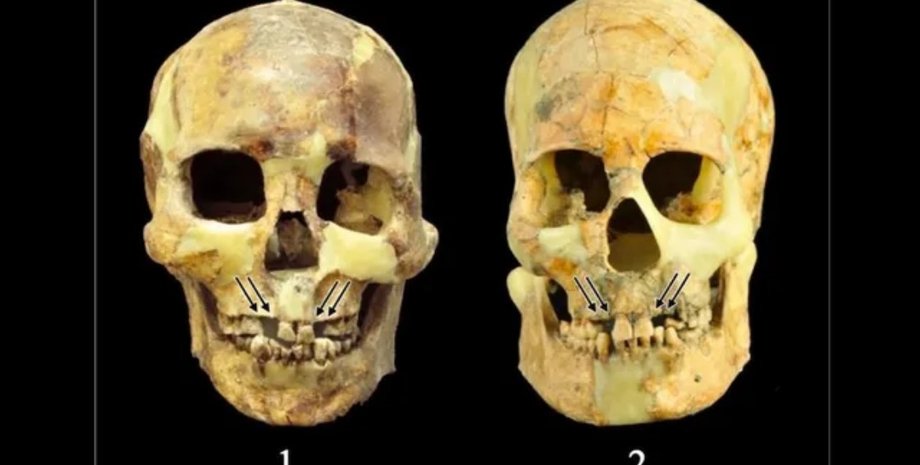 зубы, удаление зубов