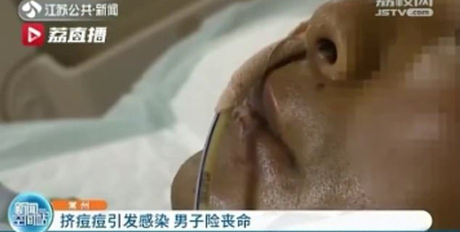 Акне, прыщ, выдавил, заражение