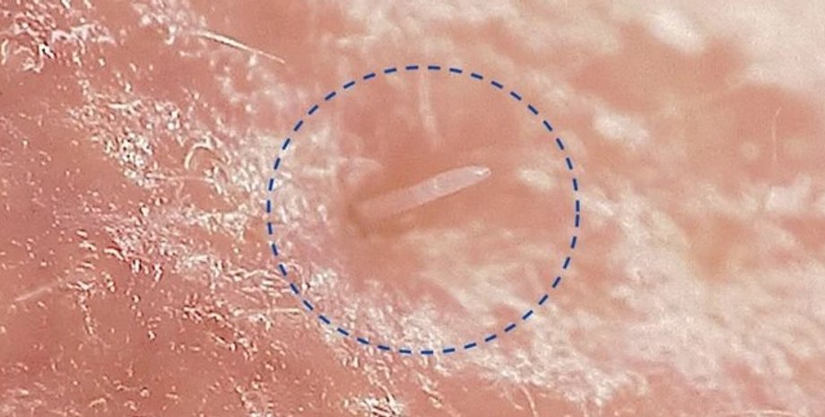 Demodex folliculorum