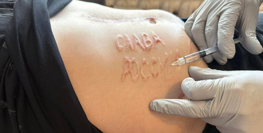 полонений, напис слава росії, обмін полоненими, хірург, андрій переверзєв, війна в  україні