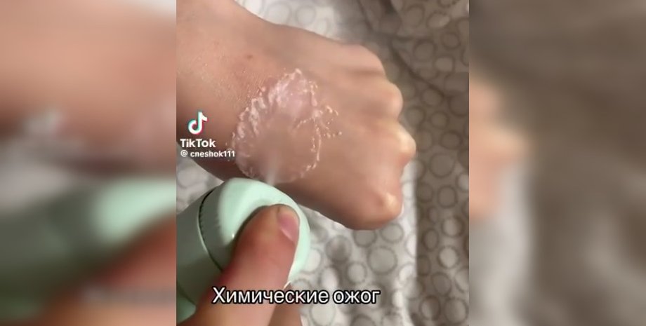 тренд у TikTok, Опік як Тайлер Дерден, Опік як Тайлер Дерден TikTok, хімічний опік TikTok