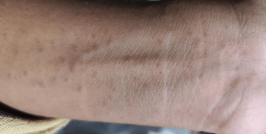 Молодой человек опубликовал в Reddit фото непонятной сыпи