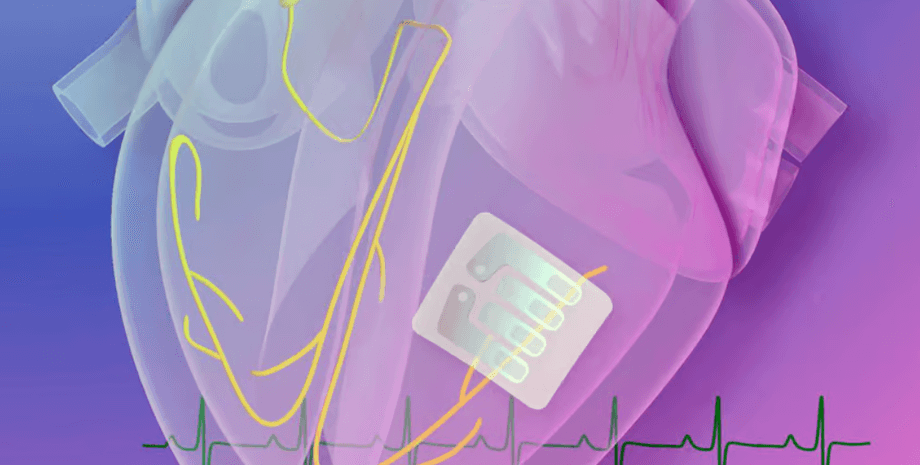 стимулятор, сердце, имплантат