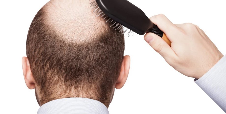 Лисий, чоловік, облисіння, випадання волосся