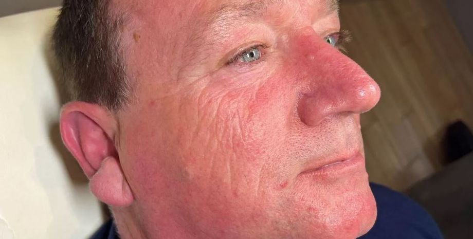 Вплив сонячного світла на шкіру обличчя, водій вантажівки провів невільний експеримент і показав ефект за 30 років