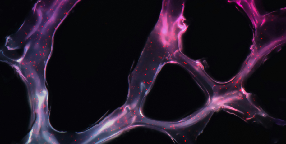 клетка рака под микроскопом микроскоп, рак, клетка, онкология, болезнь
