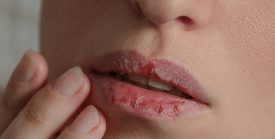 потріскані губи губи, жінка, рука