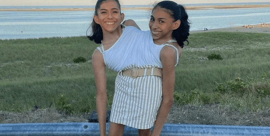 Сиамские близнецы, сестры, девушки,