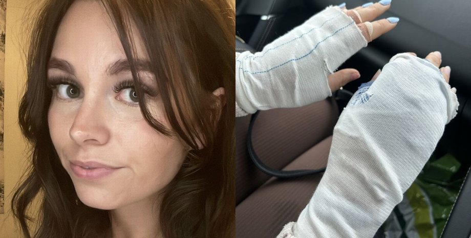 Опік руки, руки, британка, торкнулася отруйної рослини, перервала відпустку, потрапила до лікарні, пухирі на руках, опік