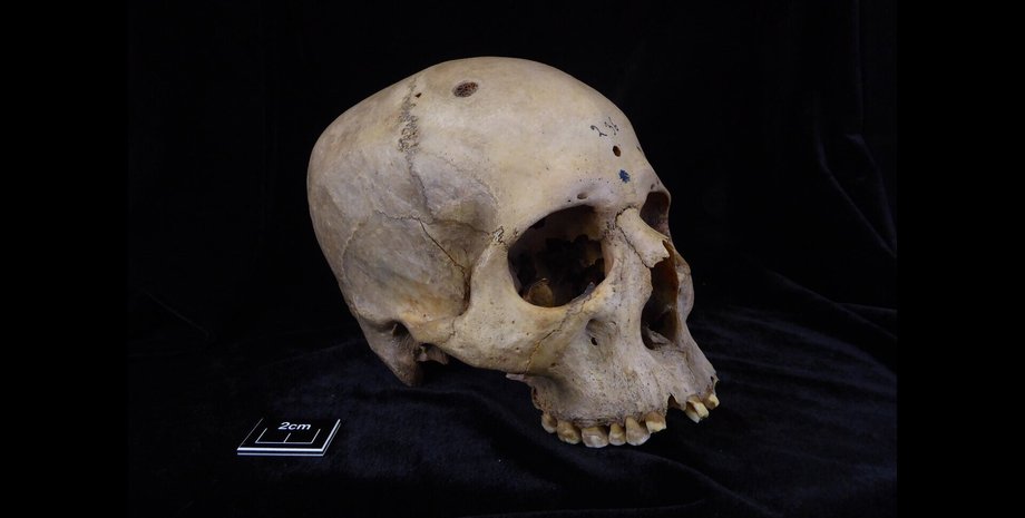 рак, онкологія, лікування, Стародавній Єгипет, череп, хвороба, останки, університет, руйнування, травма, дослідження, археологи, археологія, скелет