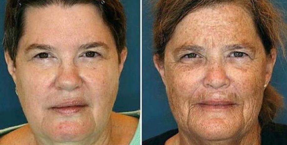 Як куріння та перебування на сонці впливають на старіння людини, експеримент з ідентичними близнючками