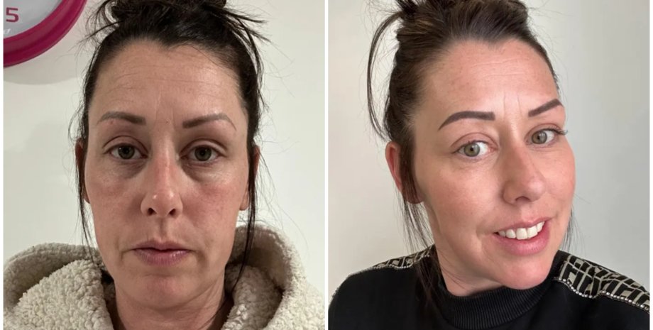 Як позбутися темних кіл під очима за допомогою сирої картоплі, лайфхаки, методи, краса, зовнішність