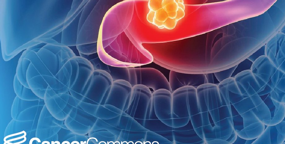 рак поджелудочной железы