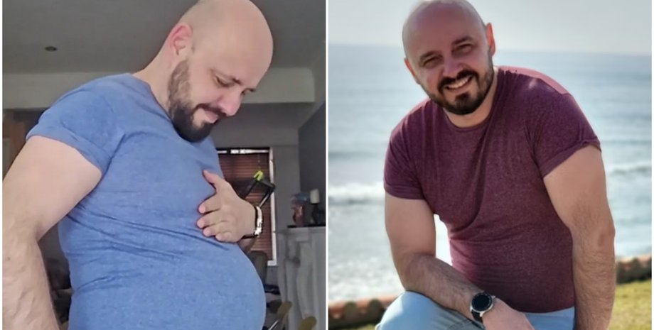 Чоловік з грижею має вигляд, наче на 7 місяці вагітності, Пол Мілхем, Велика Британія, операція