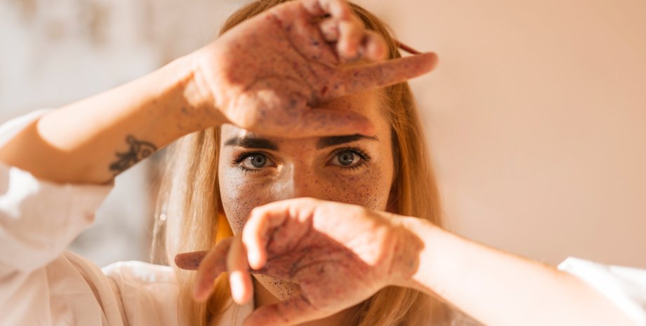 Пігментні плями