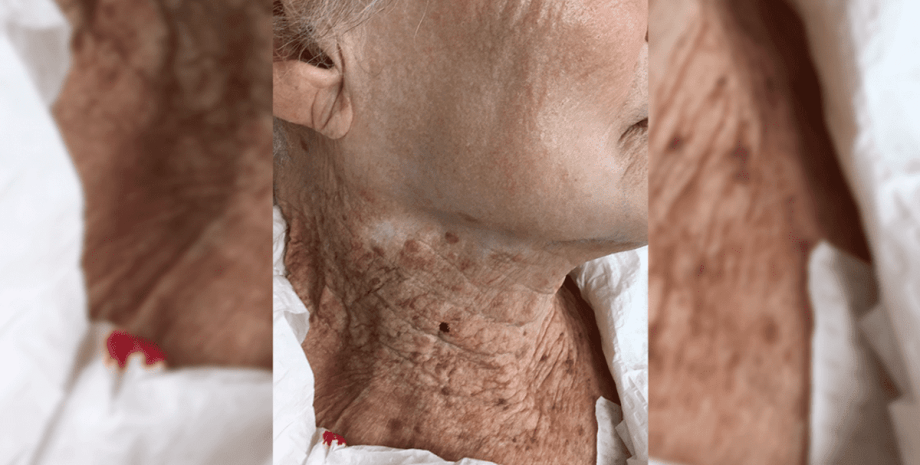 Яркий пример. Ученые показали, что будет, если наносить SPF на лицо, но не  шею (фото)