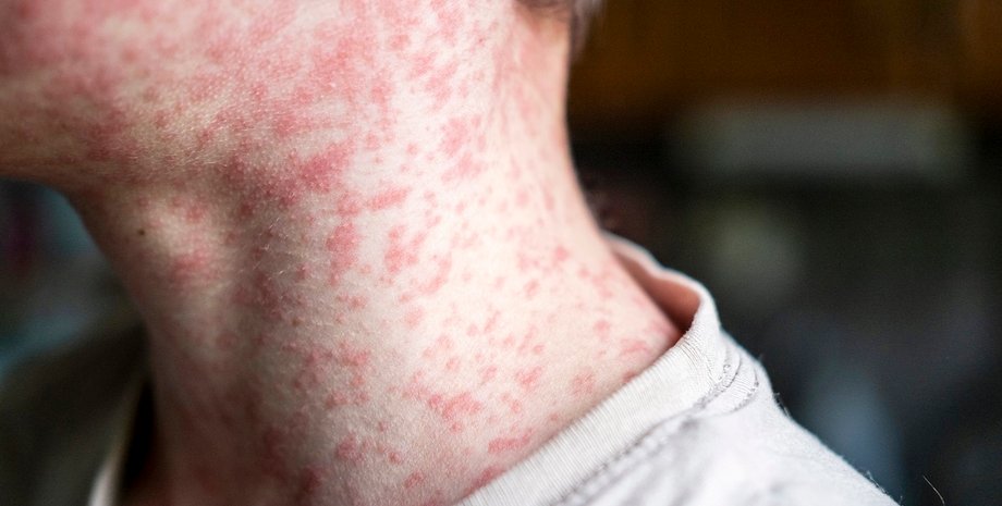 корь, инфекционное заболевание