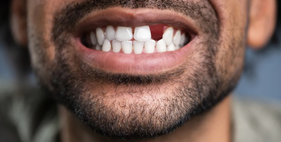 зуби, без зубів, втрачені зуби