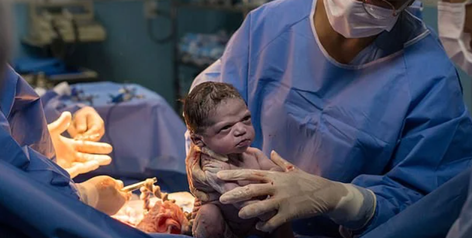 Девочка-мем, курьезное фото во время операции, акушерство, Изабель Роша, состаренное лицо, Бразилия