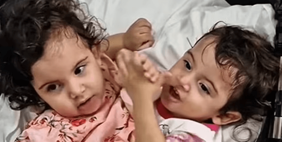 Сиамские близнецы, разделение, сложная хирургическая операция, уникальная медицинская процедура, соединенные близнецы